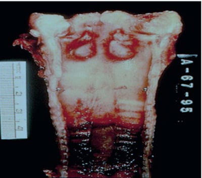 figure-4-tracheal mucosal ulceration