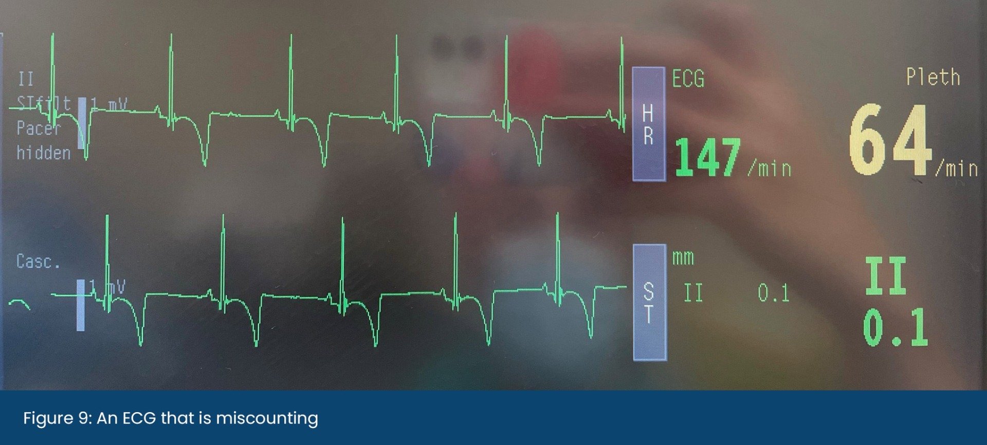 An ECG that is miscounting